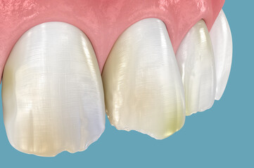 Broken and damaged front teeth. 3D illustration