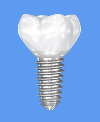Dental implant on isolated blue background. 3D illustration
