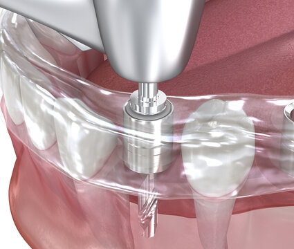 Surgical guide for implantation procedure. Dental 3D illustration
