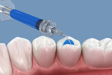 Phosphoric acidselective enamel etching of the tooth. Medically accurate tooth 3D illustration.