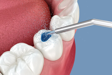 Cleaning with water of the tooth. Medically accurate tooth 3D illustration.