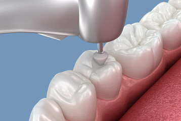 Teeth polishing procedure after filling placement. Dental 3D illustration