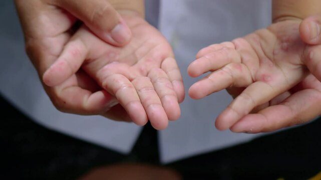 Hand, foot and mouth disease HFMD Human hand of scarlet fever in coxsackievirus palmarosa virus and child hand on white background