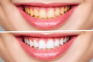 Teeth Whitening Transforming Your Appearance Before and After for Stunning Results