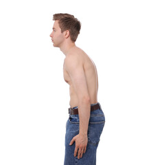 Fototapeta premium Man before scoliosis treatment on white background