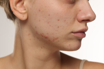 Studio closeup of young woman with acne on cheek and jawline, skincare concept, white background