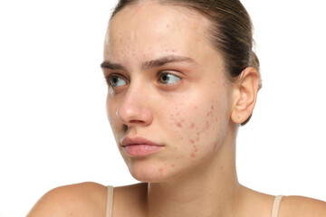 Studio shot of young woman with acne looking away, skincare concept, white background