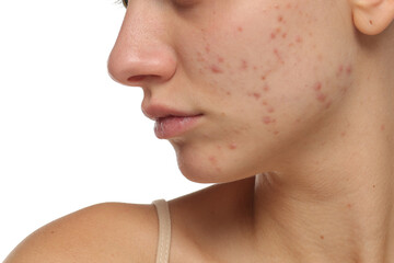 Studio closeup of young woman with acne on cheek and jawline, skincare concept, white background