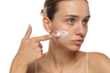 Young woman with acne applying face cream, studio shot on white background