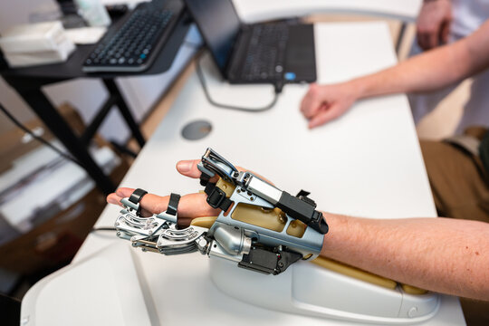 Patient testing futuristic robotic hand prosthesis in medical facility