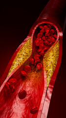 Vascular damage, artery clogging, and plaque buildup from junk food, high sugar consumption, processed foods, alcohol abuse, and poor lifestyle choices affecting heart health. 3D Rendering