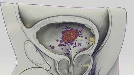 Conceptual 3D illustration of a bladder cancer