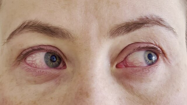 Close-Up of Upset Young Woman Suffering from Eye Pain Looking at Camera