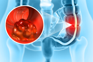 Colon cancer. Cancer attacking cell. Colon disease concept. 3d illustration