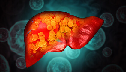 Liver damage such as Fatty liver, Fibrosis, Cirrhosis, and Liver cancer. 3d illustration