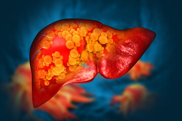 Liver damage such as Fatty liver, Fibrosis, Cirrhosis, and Liver cancer. 3d illustration