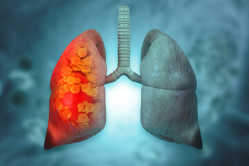 Medical Illustration showing lung cancer or bronchial carcinoma. 3d illustration