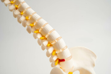 Spinal nerve and bone, Lumbar spine displaced herniated disc fragment, Model for treatment medical...