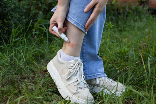 Close up of woman applying insect bite cream to mosquito bite on ankle. Concept of insect bite relief and skin care.