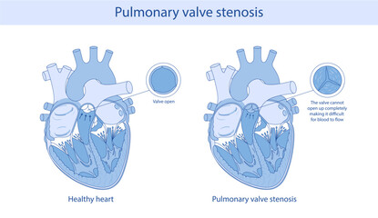pulmonary valve stenosis. anatomical illustration