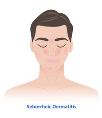 Seborrheic Dermatitis on man face vector illustration. Sebderm, inflamed skin, scaly patches, flakes over the oilier areas of the face, over the eyebrows, sides of the nose, beard area, ears, eyelids.