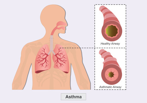 Asthma is a condition in which airways narrow.