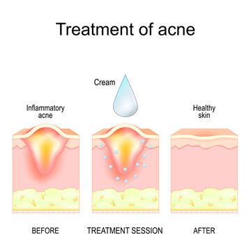 Inflammatory acne pimple before and after treatment rocedure