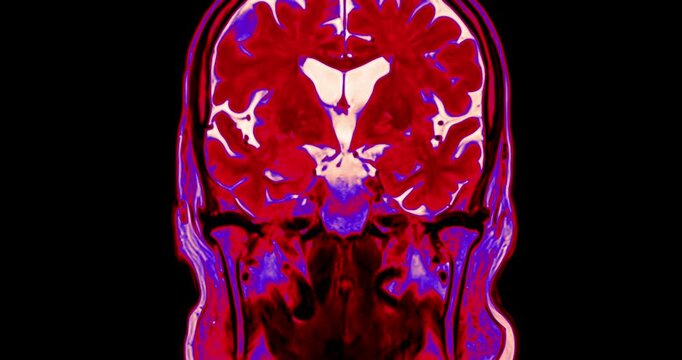 MRI brain scan with color highlights  offering detailed insights into blood flow and brain function. Essential for accurate diagnosis and treatment planning.