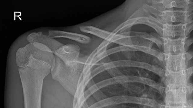 Displaced right clavicle fracture X-ray, with misalignment of bone ends.