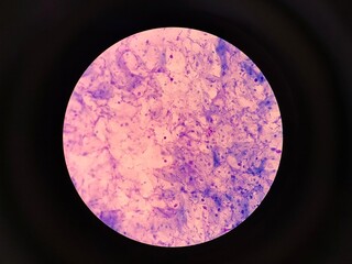 Fungal Spores in Urogenital Smear, Candidiasis Diagnosis Concept