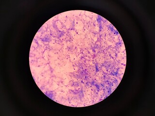 Fungal Spores in Urogenital Smear, Candidiasis Diagnosis Concept