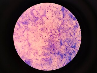 Fungal Spores in Urogenital Smear, Candidiasis Diagnosis Concept