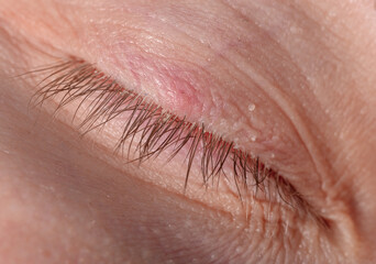 Demodicosis, sticky eyelashes and stye on the eyelid
