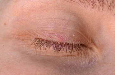 Fototapeta premium demodex in the eye, glued eyelashes and red eyelid with a lump under the skin