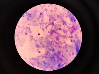 Fungal Spores in Urogenital Smear, Candidiasis Diagnosis Concept