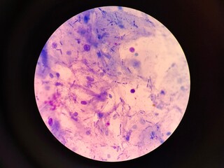 Fungal Spores in Urogenital Smear, Candidiasis Diagnosis Concept