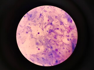 Fungal Spores in Urogenital Smear, Candidiasis Diagnosis Concept