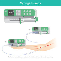 Syringe Pumps for Medical Fluid Delivery. Illustrates the use and function of a syringe pump in a medical setting for precise fluid delivery.