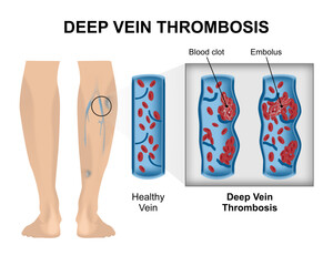 Deep Vein Thrombosis (DVT) Illustration