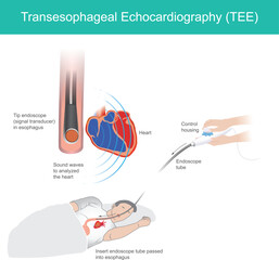 illustrates the Transesophageal Echocardiography (TEE) procedure, a diagnostic medical imaging technique used to obtain detailed images of the heart.