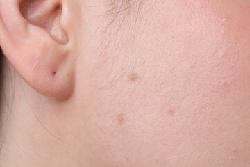 Woman with moles on her face, closeup