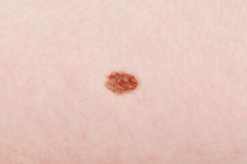 Woman with mole on her body, closeup