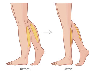 Calfs before and after weight loss. Slimming of calfs vector illustration.