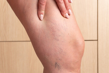 Macro view of spider veins on a female leg with hand touching, realistic detail for medical, dermatology, cosmetic, or educational projects.