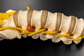 Lumbar Disc Herniation Pressing on Nerve Root