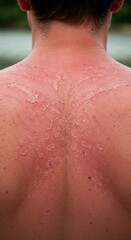 Fototapeta premium Sunburned back of young man showing skin irritation after beach 