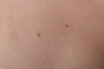 Woman with moles on her body, closeup