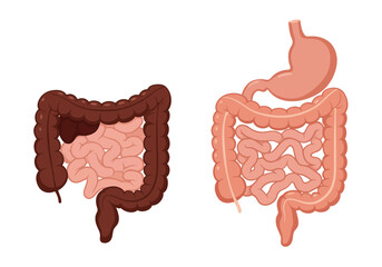 Healthy vs Unhealthy Digestive System Illustration.