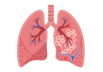 Anatomical Lungs Illustration with Bronchioles Alveoli and Vascular System.
