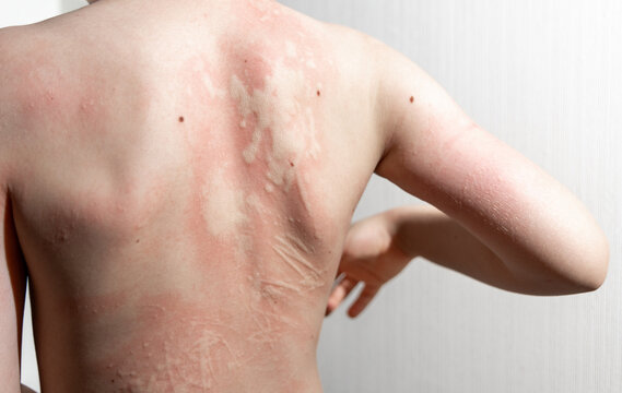 Kid with an aggressive form of hives, nettle rash on back. Child with inflamed ear on white background scratching skin. Red, itchy welts common in children's allergic skin reactions.